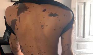 Atacan a madre e hija con ácido del diablo; acusan a hermanas de hombre denunciado por abuso sexual