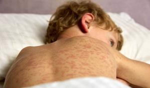 Con más mil casos, tres muertes y 128 hospitalizados, el sarampión se extiende por EE. UU.