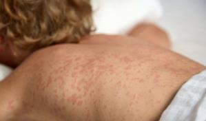 EE. UU. atraviesa su peor epidemia de sarampión en el siglo XXI, según universidad