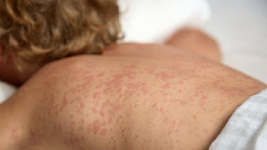 EE. UU. atraviesa su peor epidemia de sarampi&oacute;n en el siglo XXI, seg&uacute;n universidad
