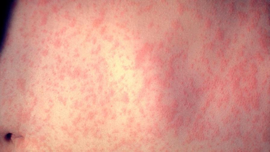 Sociedad de Infectología llama a completar vacunas para mantener cobertura frente al sarampión Sociedad de Infectología llama a completar vacunas para mantener cobertura frente al sarampión