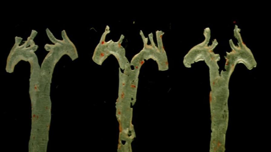 Una molécula generada por bacterias intestinales, nuevo factor clave de la aterosclerosis Una molécula generada por bacterias intestinales, nuevo factor clave de la aterosclerosis
