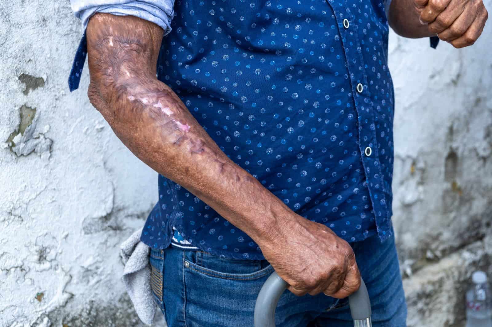 Quemaduras ocasionadas por la explosión.