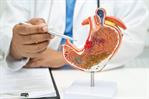 La prevención del cáncer de páncreas es posible con hábitos saludables