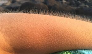 ¿Por qué se te pone la piel de gallina y qué lo provoca?