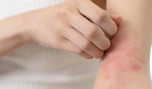 ¿Puede la alimentación realmente influir en la dermatitis atópica?