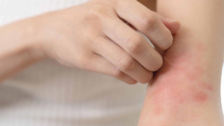 ¿Puede la alimentación realmente influir en la dermatitis atópica?
