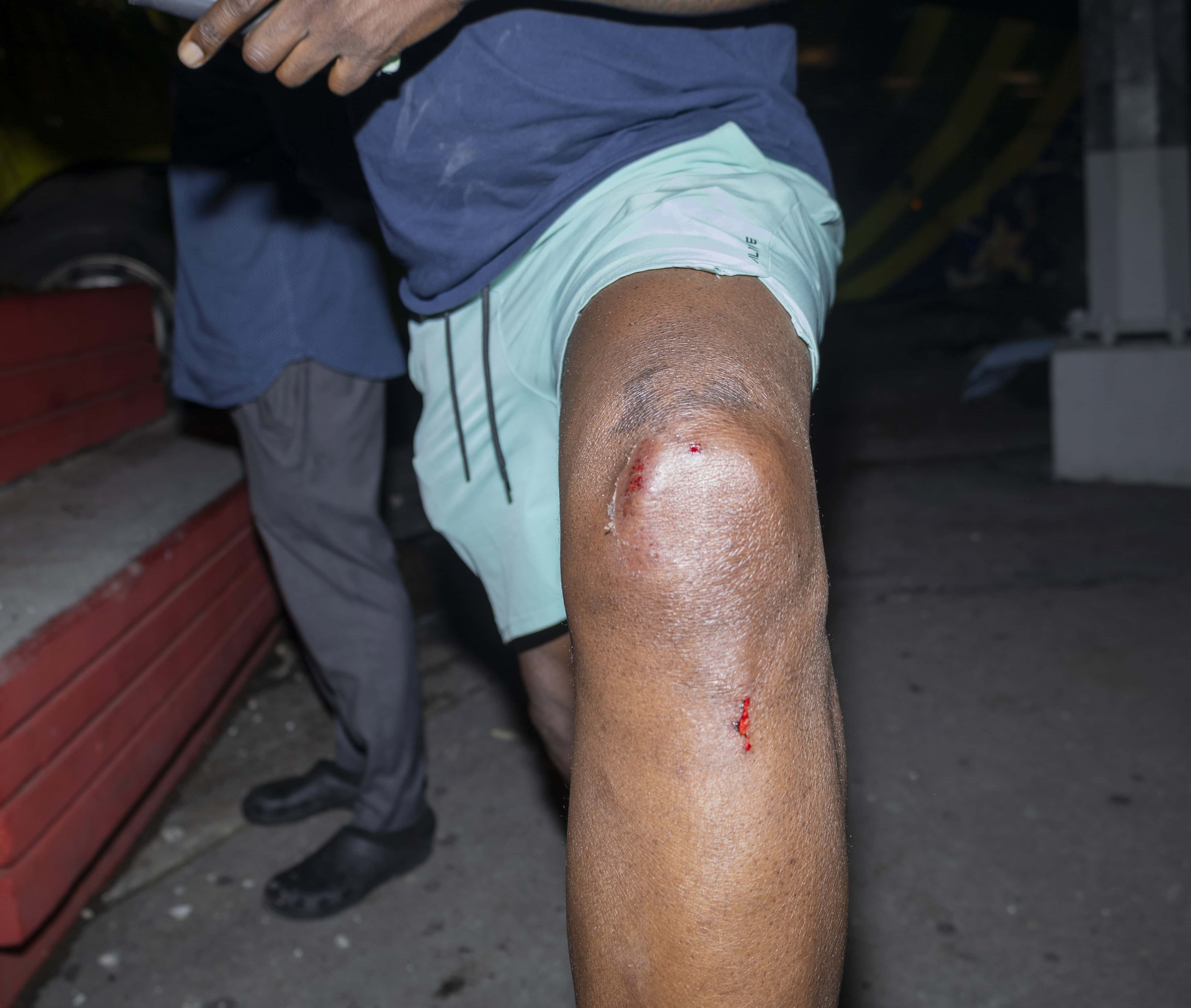 Elwin Ricardo Jupiter, uno de los pasajeros, muestra los rasguños en una de sus piernas. 
