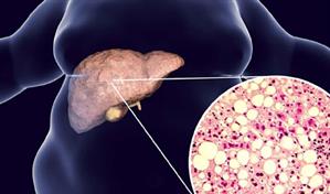 Dos fármacos cardiovasculares ayudan a tratar la enfermedad hepática metabólica