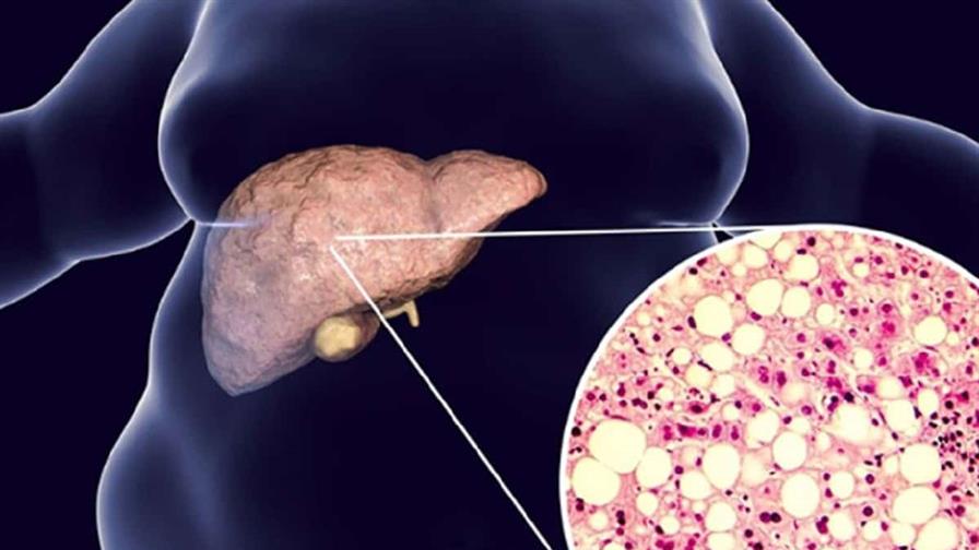 Dos fármacos cardiovasculares ayudan a tratar la enfermedad hepática metabólica