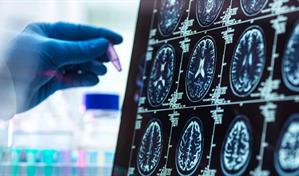 Científicos visualizan por primera vez el desencadenante del párkinson en el cerebro