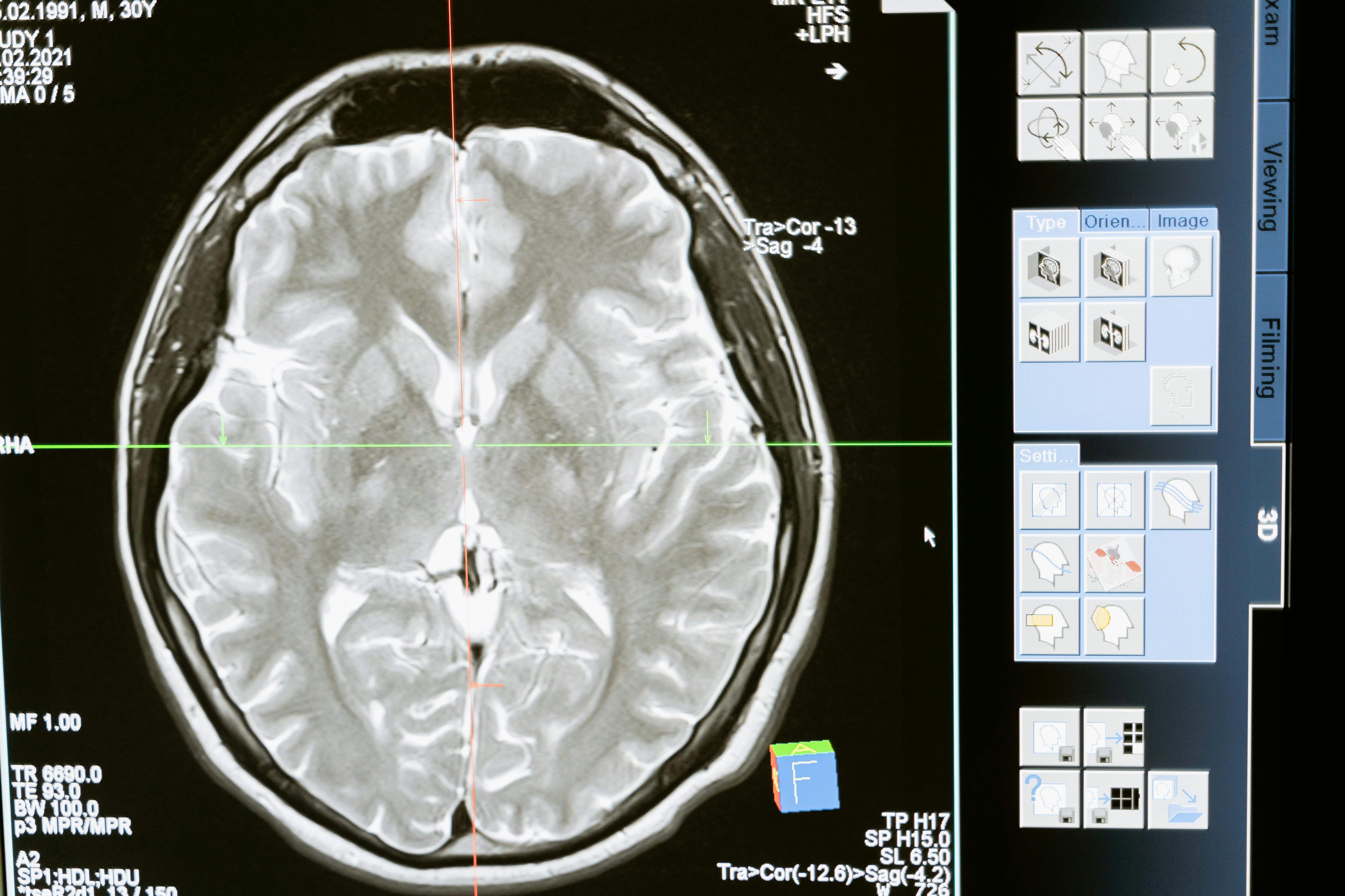 La exposición de los homínidos al plomo influyó en la evolución del cerebro La exposición de los homínidos al plomo influyó en la evolución del cerebro