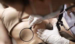 Pecas y lunares: lo que tu piel revela sobre ti