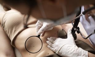 Pecas y lunares: lo que tu piel revela sobre ti