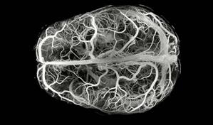Descubren una enfermedad ultrarrara con solo 13 casos en el mundo
