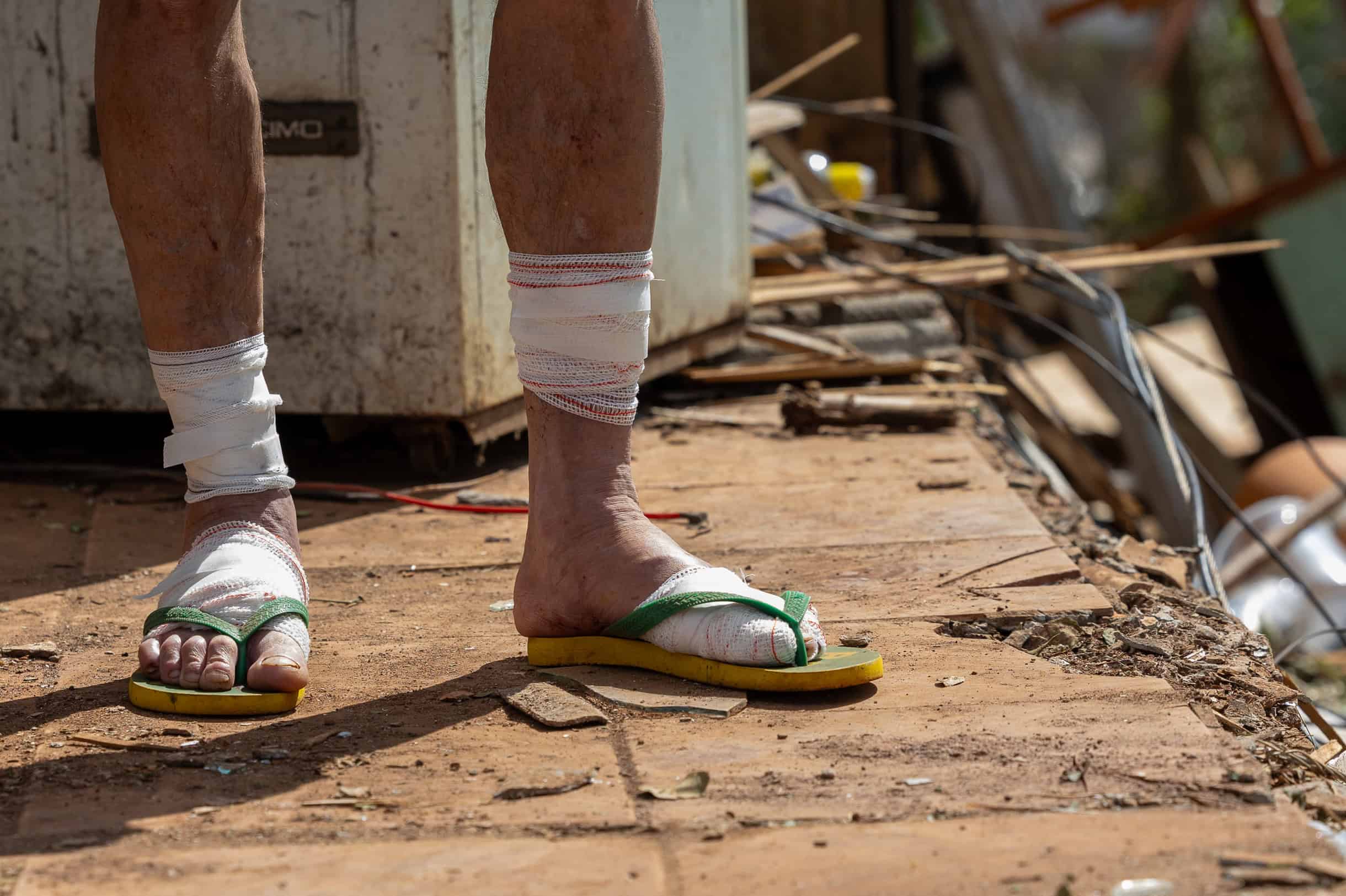José Acir, de 61 años, posa con sus piernas vendadas este domingo, en la ciudad de Rio Bonito do Iguaçu, estado de Paraná (Brasil). Las cerca de 700 familias a las que un violento tornado dejó sin viviendas el pasado viernes en Río Bonito do Iguaçu, dicen que lo perdieron todo y que no saben cuánto tardarán en reerguir lo que demoraron toda la vida para construir. <br>
