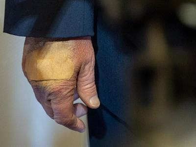 Casa Blanca por qué Donald Trump tiene la mano vendada