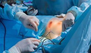 Realizan la primera cirug&iacute;a de reducci&oacute;n mamaria en el pa&iacute;s cubierta por una ARS