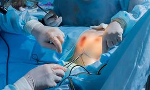 Realizan la primera cirug&iacute;a de reducci&oacute;n mamaria en el pa&iacute;s cubierta por una ARS