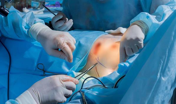 Realizan la primera cirug&iacute;a de reducci&oacute;n mamaria en el pa&iacute;s cubierta por una ARS