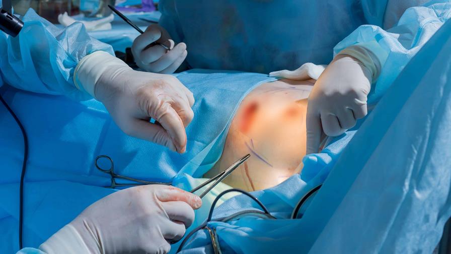 Realizan la primera cirug&iacute;a de reducci&oacute;n mamaria en el pa&iacute;s cubierta por una ARS