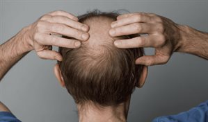 Ni minoxidil ni finasterida: este es el f&aacute;rmaco que podr&iacute;a cambiar las reglas de la alopecia