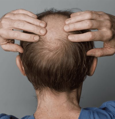 Ni minoxidil ni finasterida: este es el f&aacute;rmaco que podr&iacute;a cambiar las reglas de la alopecia