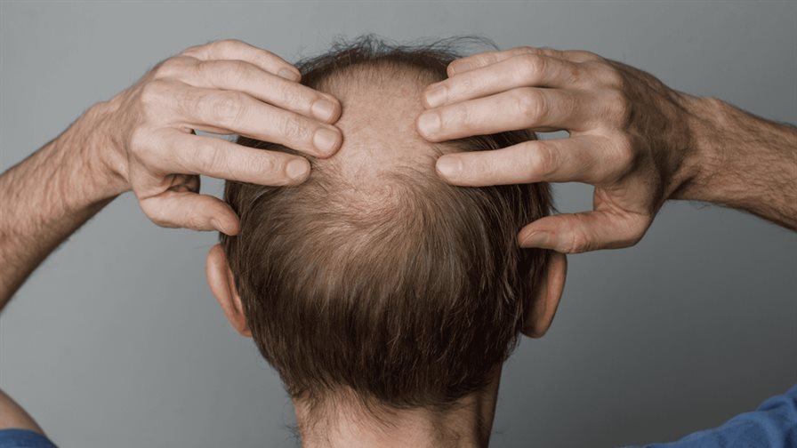 Ni minoxidil ni finasterida: este es el f&aacute;rmaco que podr&iacute;a cambiar las reglas de la alopecia