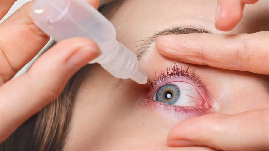 Conjuntivitis, una manifestaci&oacute;n que puede estar asociada a la circulaci&oacute;n de virus respiratorios