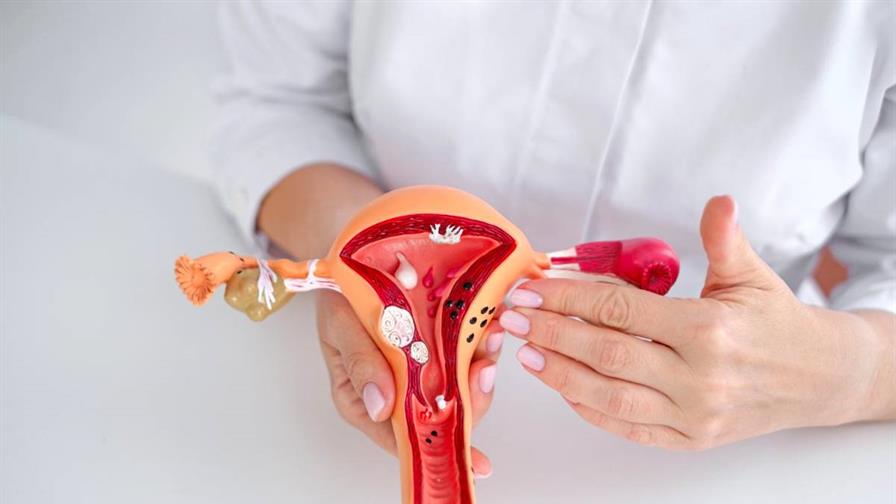 Endometriosis y s&iacute;ndrome de ovario poliqu&iacute;stico