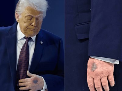 Moretones en mano de Donald Trump generan preocupación