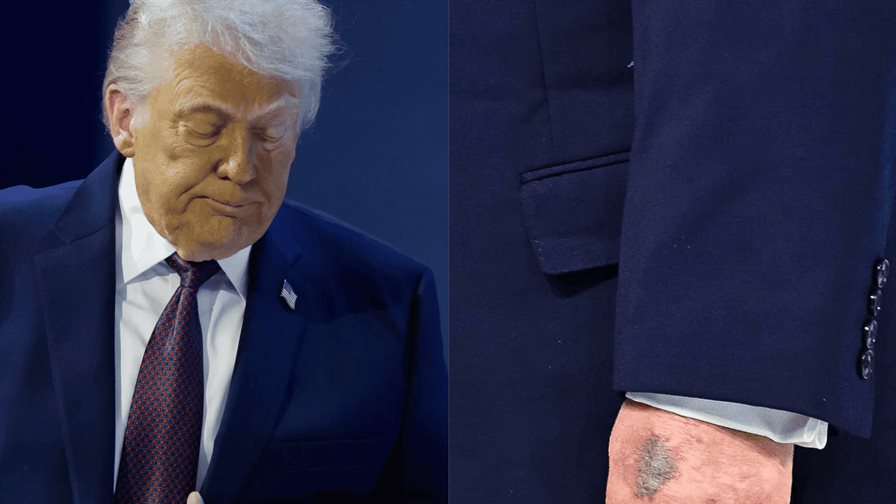 Casa Blanca atribuye moretones de Trump a golpe contra la mesa Casa Blanca atribuye moretones de Trump a golpe contra la mesa