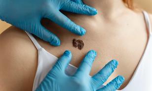 El c&aacute;ncer de piel avanza en silencio en Rep&uacute;blica Dominicana, alerta el Instituto Dermatol&oacute;gico