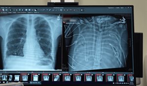 Un sistema de respiraci&oacute;n artificial mantiene vivo a un paciente hasta el trasplante