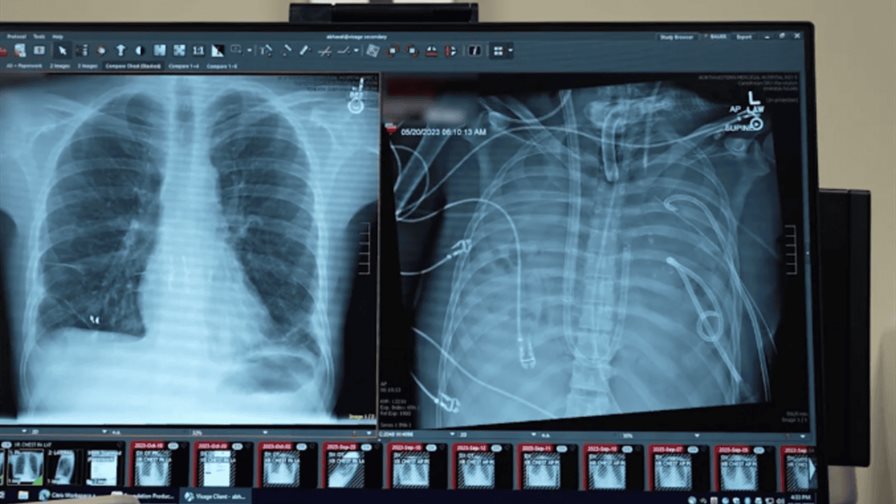 Un sistema de respiraci&oacute;n artificial mantiene vivo a un paciente hasta el trasplante