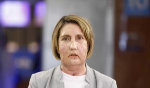 Barcelona hace el primer trasplante facial del mundo con donante que recibi&oacute; la eutanasia