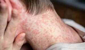 M&eacute;xico supera los 10,000 casos de sarampi&oacute;n en un brote que ha provocado 31 fallecidos