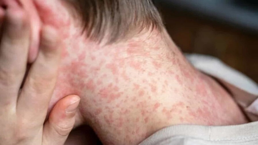 M&eacute;xico supera los 10,000 casos de sarampi&oacute;n en un brote que ha provocado 31 fallecidos