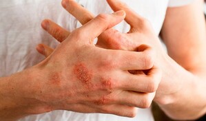 Dermatitis at&oacute;pica, c&oacute;mo evitarla