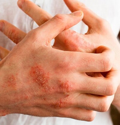Dermatitis at&oacute;pica, c&oacute;mo evitarla