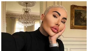 El rey de los labios, influencer que gast&oacute; miles de d&oacute;lares en cirug&iacute;as, muere por su obsesi&oacute;n