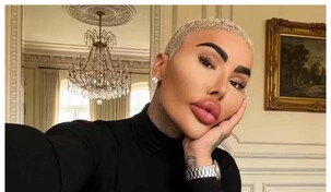 El rey de los labios, influencer que gast&oacute; miles de d&oacute;lares en cirug&iacute;as, muere por su obsesi&oacute;n