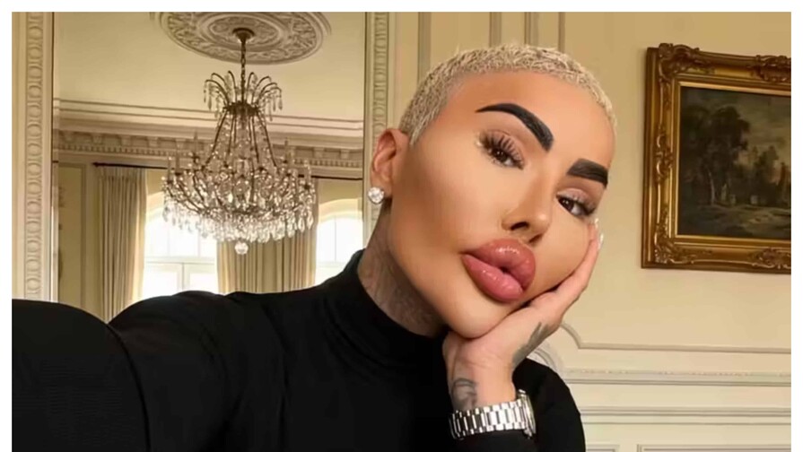 El rey de los labios, influencer que gastó miles de dólares en cirugías, muere por su obsesión El rey de los labios, influencer que gastó miles de dólares en cirugías, muere por su obsesión