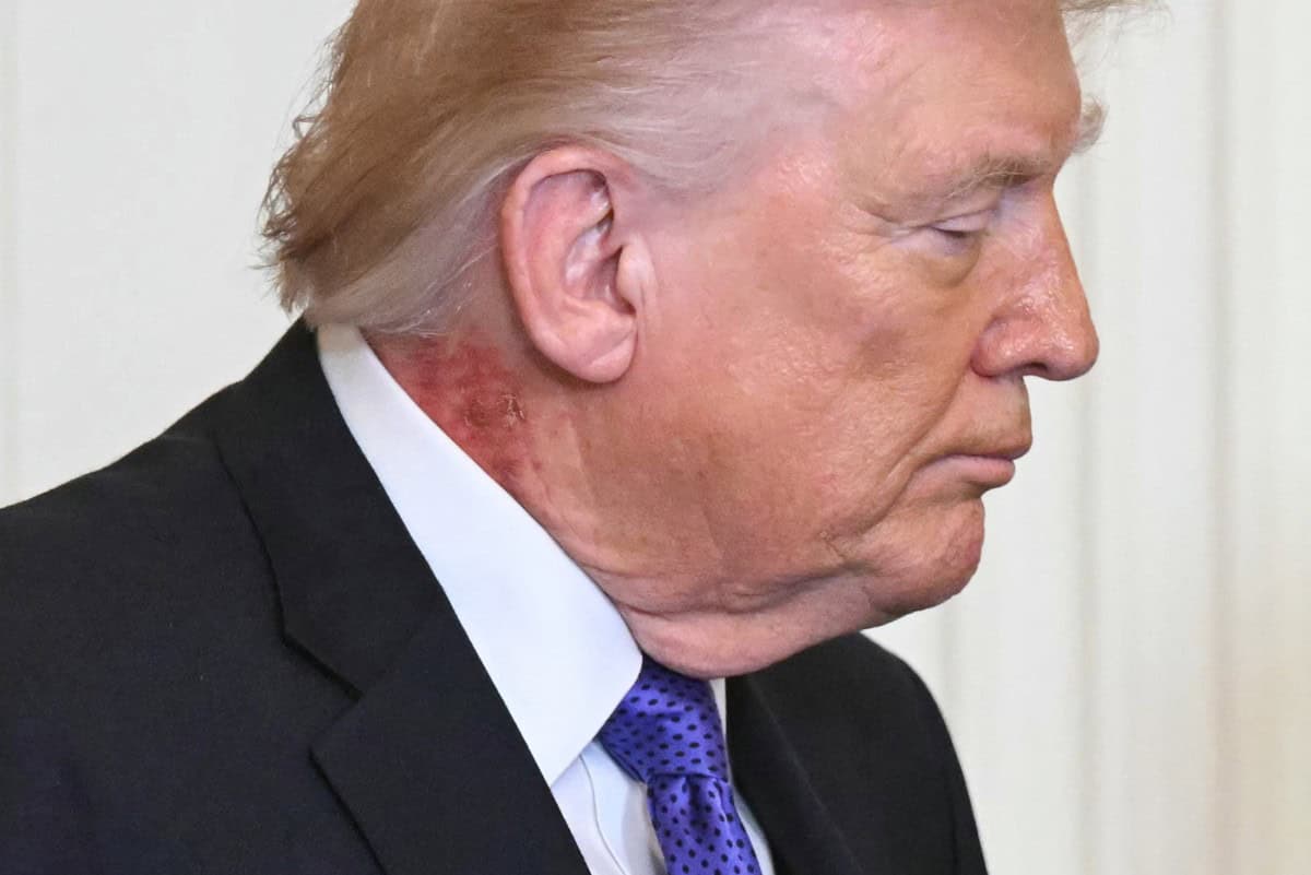 Donald Trump es visto con una gran mancha roja en el cuello