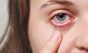 Aumentan los casos de conjuntivitis viral en las consultas oftalmol&oacute;gicas