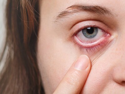 Aumentan los casos de conjuntivitis viral en consultas oftalmológicas