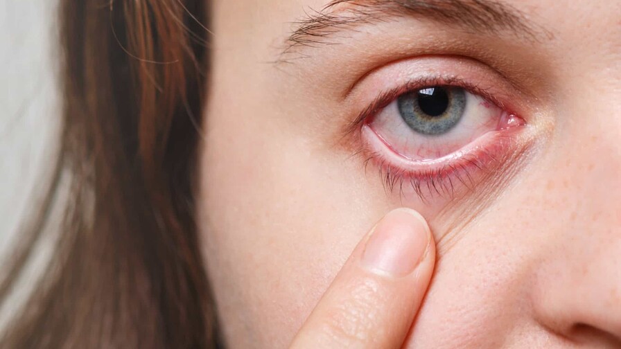 Aumentan los casos de conjuntivitis viral en las consultas oftalmol&oacute;gicas