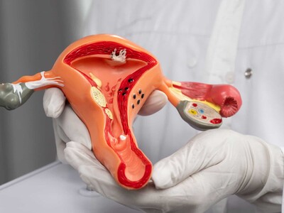 Cáncer de cérvix sigue entre los más frecuentes en RD