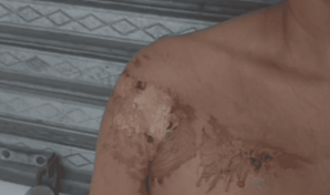 Mujer sufre quemaduras tras ser atacada con aceite caliente por presunta deuda en Moca