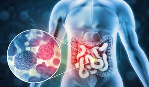 El 10 % de los diagn&oacute;sticos de c&aacute;ncer de colon se hacen antes del paciente cumplir 50 a&ntilde;os